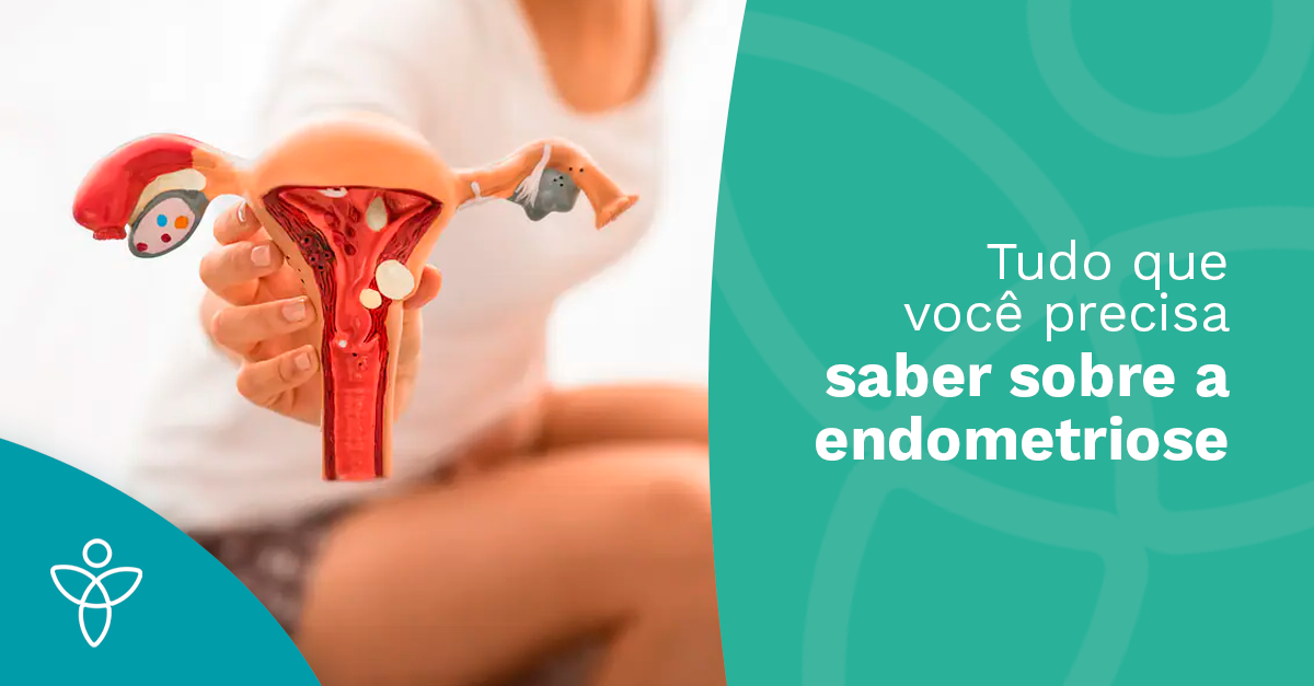 Tudo que você precisa saber sobre a endometriose