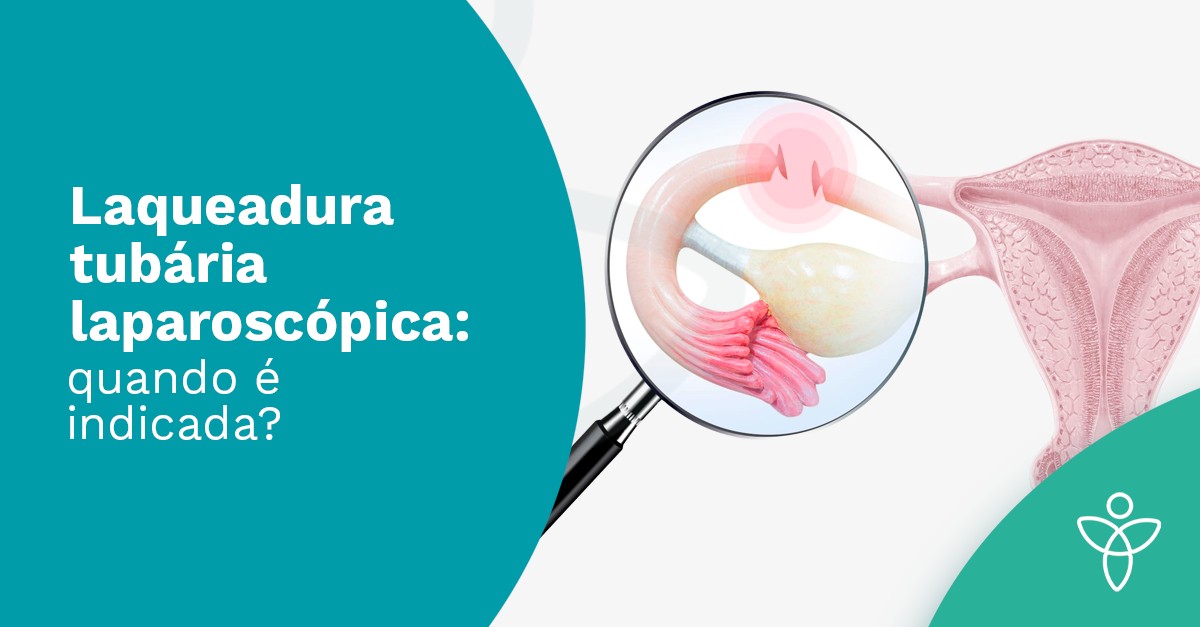 Laqueadura tubária laparoscópica: quando é indicada?